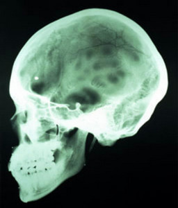 Перелом основания черепа это зчмт или очмт Перелом основания черепа это зчмт или очмт thumbnail